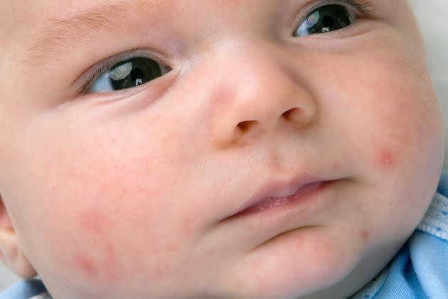 Baby Rashes Decoded: When Do You Need To Worry And What's Normal?