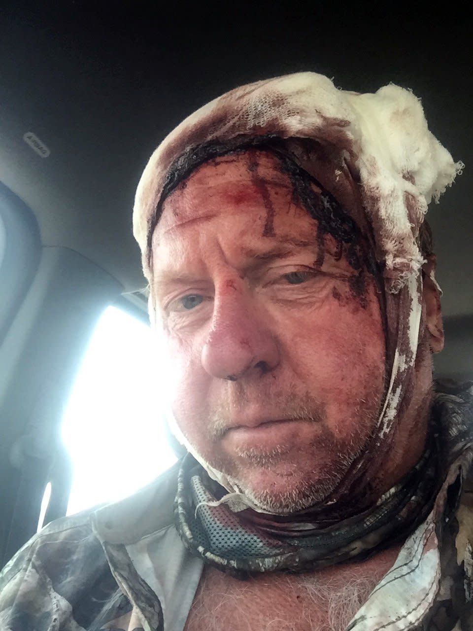 Tom Sommer after a grizzly bear mauled him on Sept. 4, 2017, in southwestern Montana.