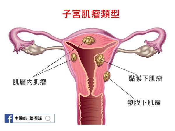 小腹突出？小心暗藏子宮肌瘤