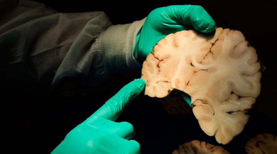 Un cerebro humano es útil para investigación y enseñanza médica, lo que aporta beneficios científicos y ayuda a pacientes. Un cerebro 'donado a la ciencia' contodo puede ser vendido por cientos de dólares en EEUU. (Archivo Yahoo) 