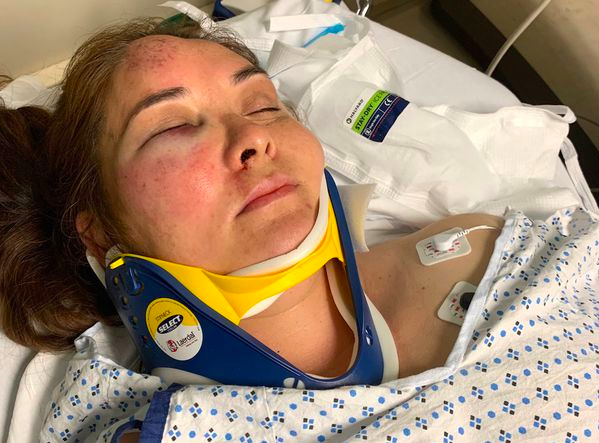 Beronica Ruiz was in the hospital for two days recovering from facial fractures, a bloodied eye, and bruises after being knocked unconscious by her son's bully. (Photo: Courtesy of Daniel Santiago)