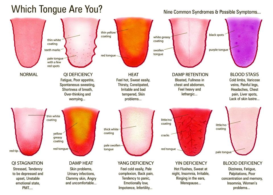 Tongue mapping (Image courtesy of AcuMedic Clinic London)