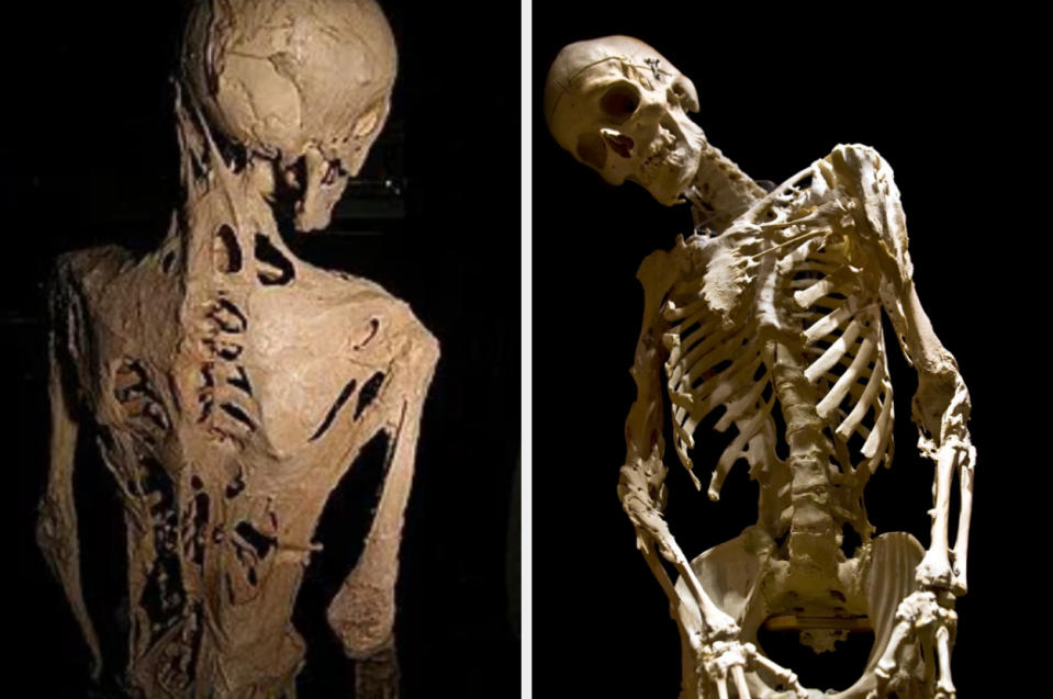 Skeleton models showing fused bones and other tissue on the shoulder and spine