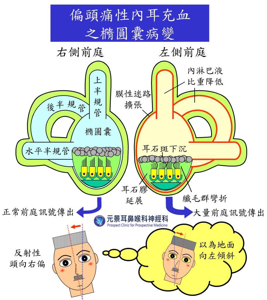 左側偏頭痛性內耳充血時，內淋巴液比重變輕，橢圓囊耳石斑向下沉，壓迫纖毛細胞，產生大量前庭訊號，使患者以為身體左側正在上升，身體及頭部便反射性地向右側偏斜，欲固定前方視覺。（醫師陳建志提供）