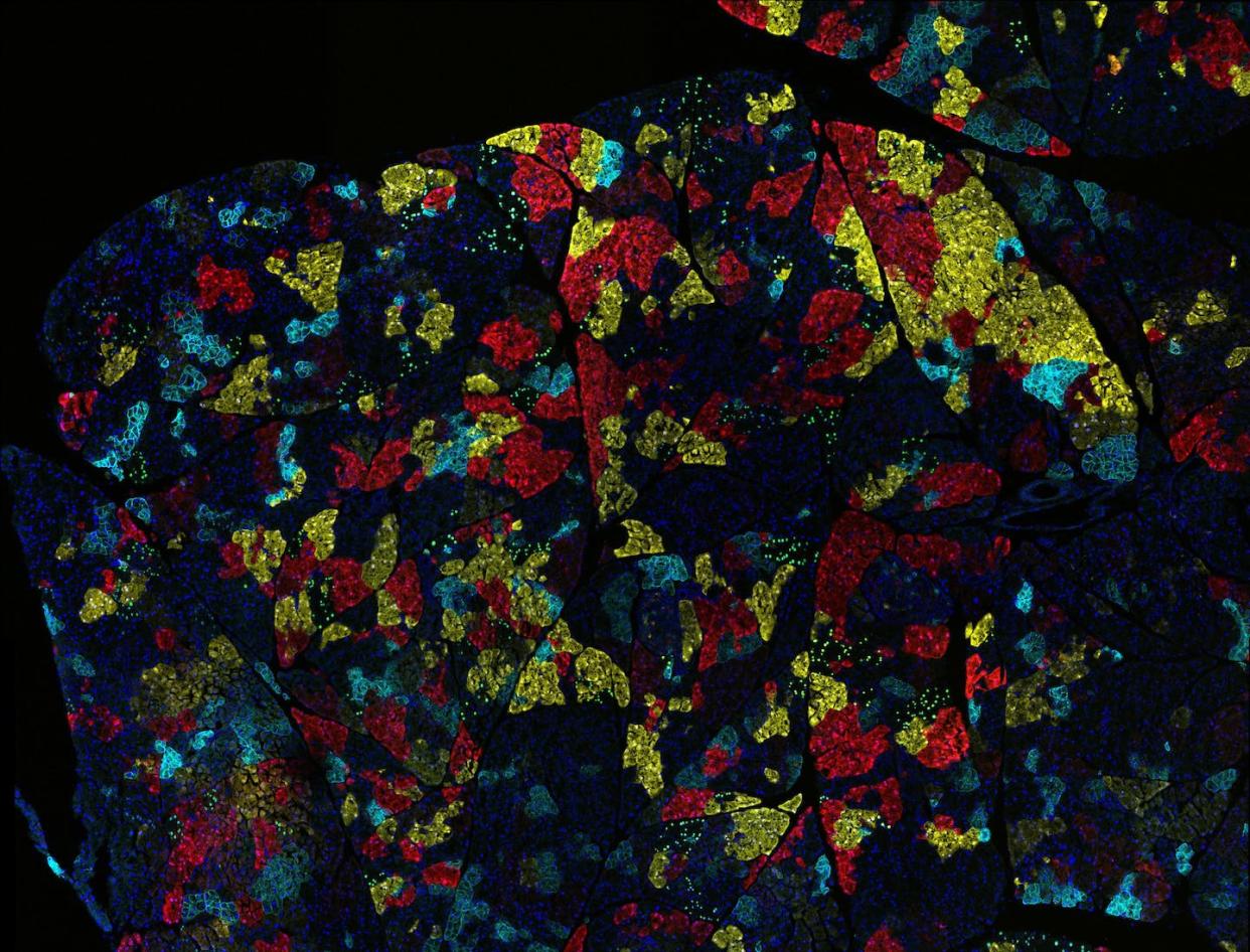 Most tumors are made up of many different kinds of cancer cells, as shown in this pancreatic cancer sample from a mouse. <a href="https://visualsonline.cancer.gov/details.cfm?imageid=10654" rel="nofollow noopener" target="_blank" data-ylk="slk:Ravikanth Maddipati/Abramson Cancer Center at the University of Pennsylvania via National Cancer Institute;elm:context_link;itc:0;sec:content-canvas" class="link ">Ravikanth Maddipati/Abramson Cancer Center at the University of Pennsylvania via National Cancer Institute</a>