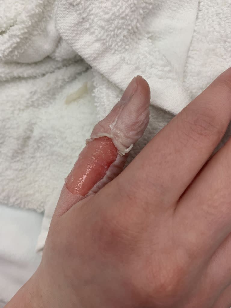 “She then ran over to the sink to rinse it off and when she did this it took her skin off too because it was so hot,” Natalie described. Kennedy News & Media