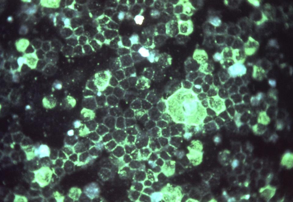 An undated image from the Centers for Disease Control and Prevention shows the presence of the respiratory syncytial virus (RSV) in an unidentified sample, RSV is the most common cause of bronchiolitis and pneumonia among infants and children under 1 year of age.