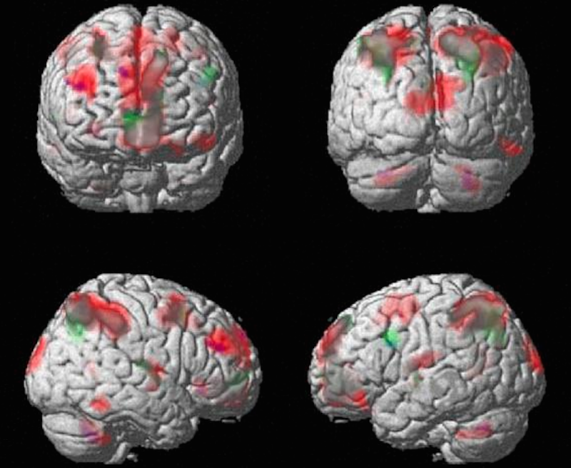 brain scan alcohol mri