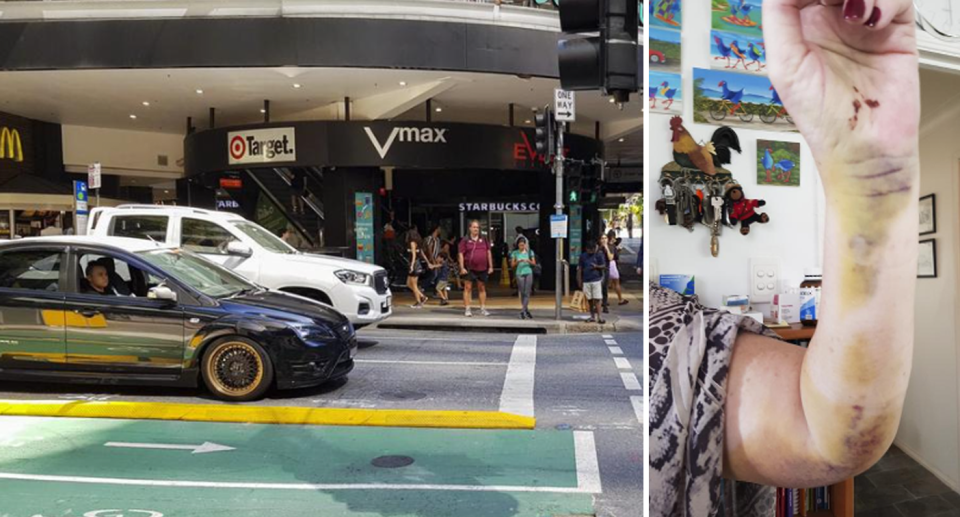 The Elizabeth St, Brisbane location where Schwass fell with the bike lane dividers on the road (left). Her arm was covered in bruises after the fall (right). 
