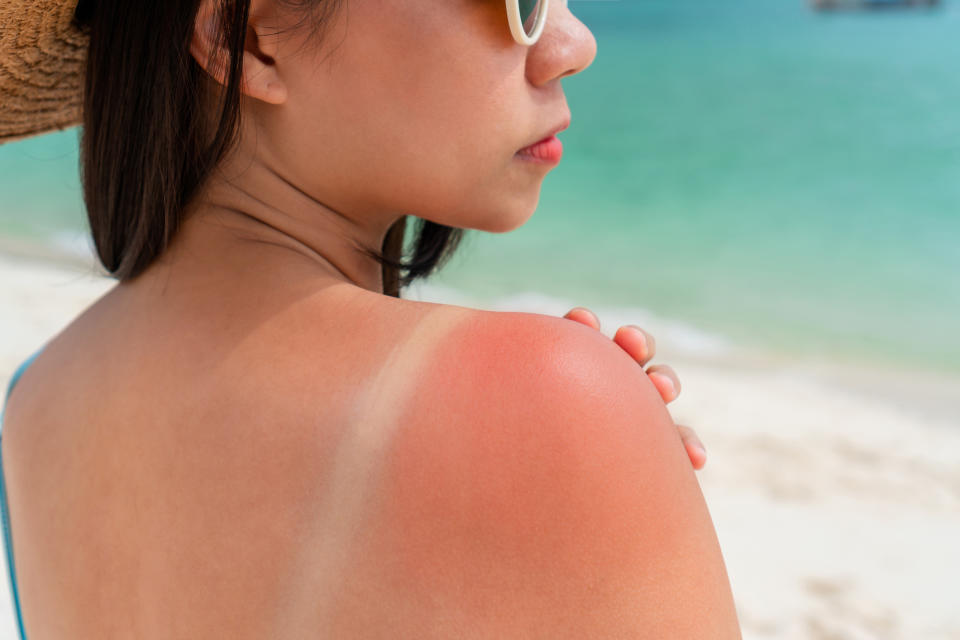 A woman with sunglasses and a straw hat displays a severe sunburn on her shoulder, highlighting a tan line, while standing on a beach
