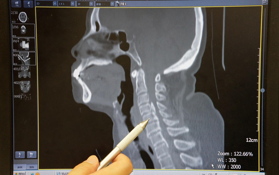 此為電腦斷層檢查影像，醫師手指處為頸椎後縱韌帶鈣化合併脊椎狹窄。