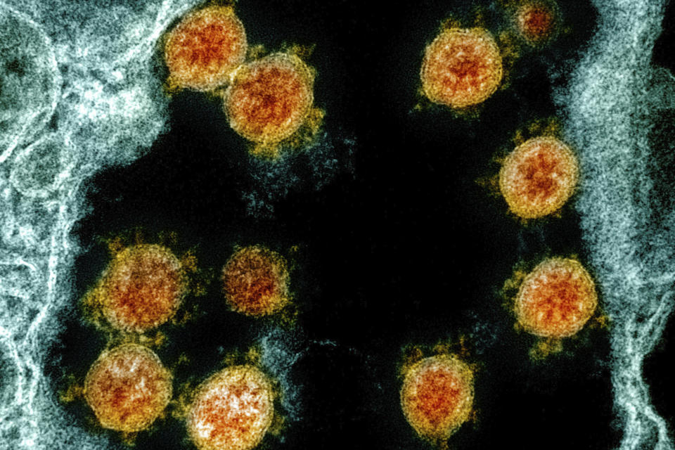 FILE - This electron microscope image made available and color-enhanced by the National Institute of Allergy and Infectious Diseases Integrated Research Facility in Fort Detrick, Md., in 2020, shows Novel Coronavirus SARS-CoV-2 virus particles, orange, isolated from a patient. One of COVID-19's scariest mysteries is why some people are mildly ill or have no symptoms and others rapidly die — and scientists are starting to unravel why. (NIAID/National Institutes of Health via AP)