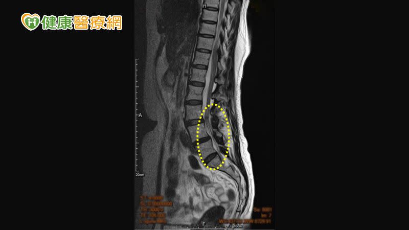 椎孔是脊髓及神經的管道，腰椎狹窄是脊椎結構退化、進而壓迫到神經，出現痠麻刺痛