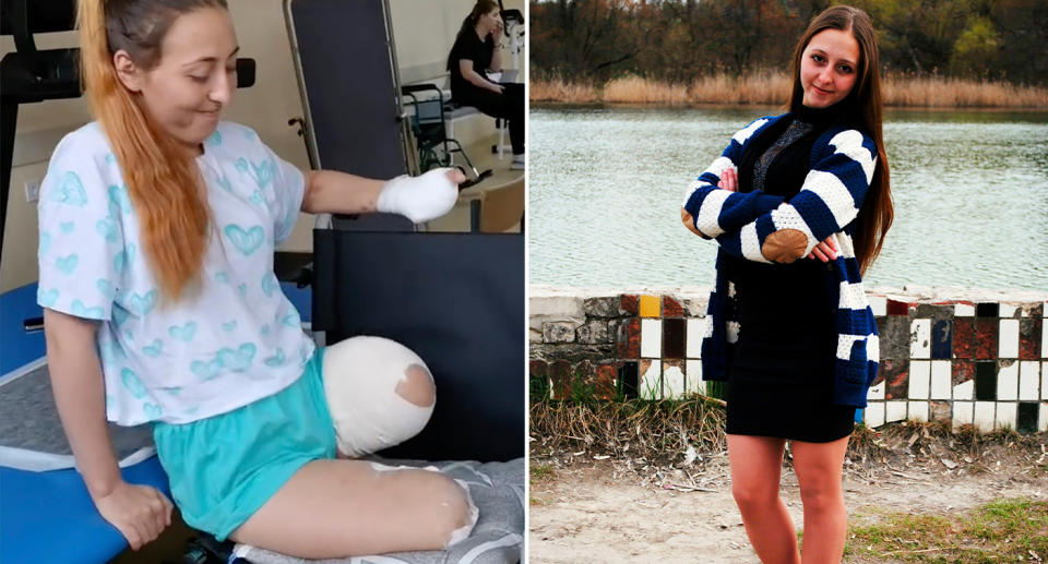 Oksana Balandina before and after her legs were blown off 'by Russian landmine'.