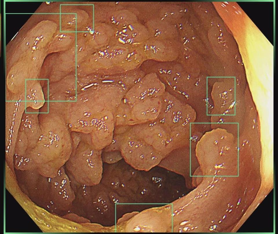 AI大腸鏡照出無數個息肉。（翻攝自胰臟醫師 林相宏 禾馨民權內科診所 臉書）