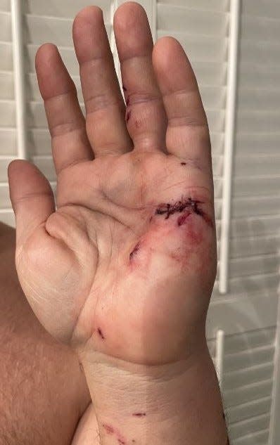 Even though he was wearing gloves, the victim of a dog attack in Jackson County needed stitches for this wound.