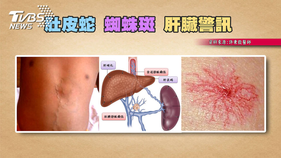 肚子出現肚皮蛇 快就醫檢查肝功能。(圖／TVBS)