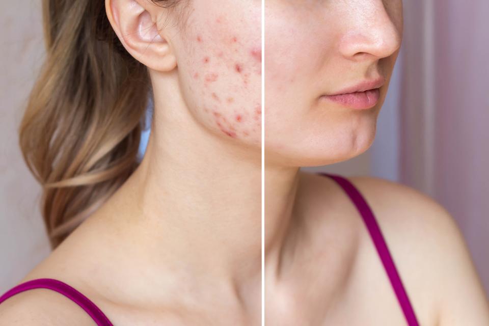 Acne-Before-After-Stock-Photo