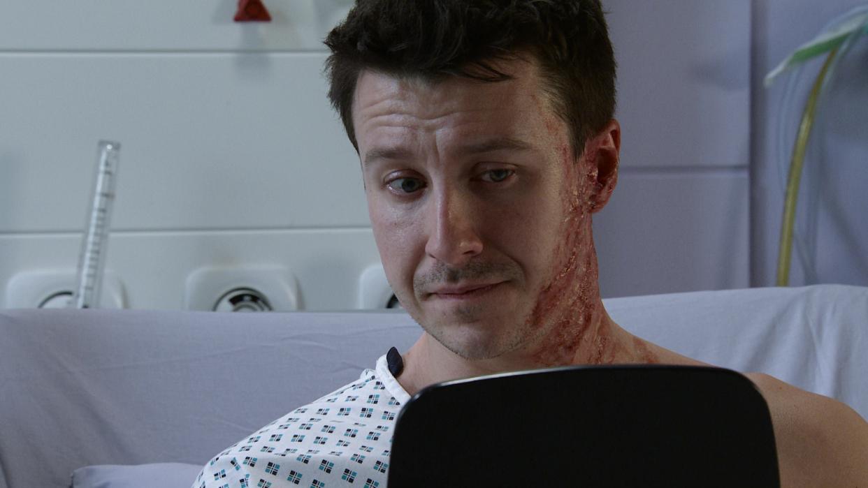 Coronation Street's Ryan sees his burns for the first time. (ITV)