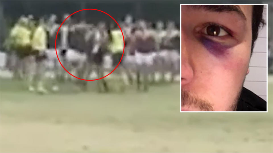 Page was left with a nasty black eye from the punches. Image: 7News