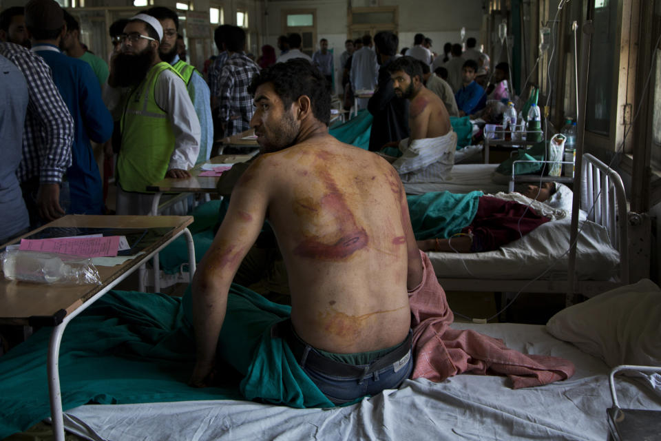 FILE - In this Aug. 18, 2016 file photo, Sameer Ahmed, a Kashmiri man allegedly beaten up by Indian soldiers at Khrew village, recovers at a local hospital in Srinagar, Indian controlled Kashmir. India has long seen the Kashmiri struggle for self-determination as Islamabad's proxy war against New Delhi. The region is one of the most heavily militarized in the world, patrolled by soldiers and paramilitary police. Most Kashmiris resent the Indian troop presence and support the rebels. For years, international rights groups have accused Indian troops of using systematic abuse and unjustified arrests to intimidate residents opposing India's rule. (AP Photo/Dar Yasin, File)