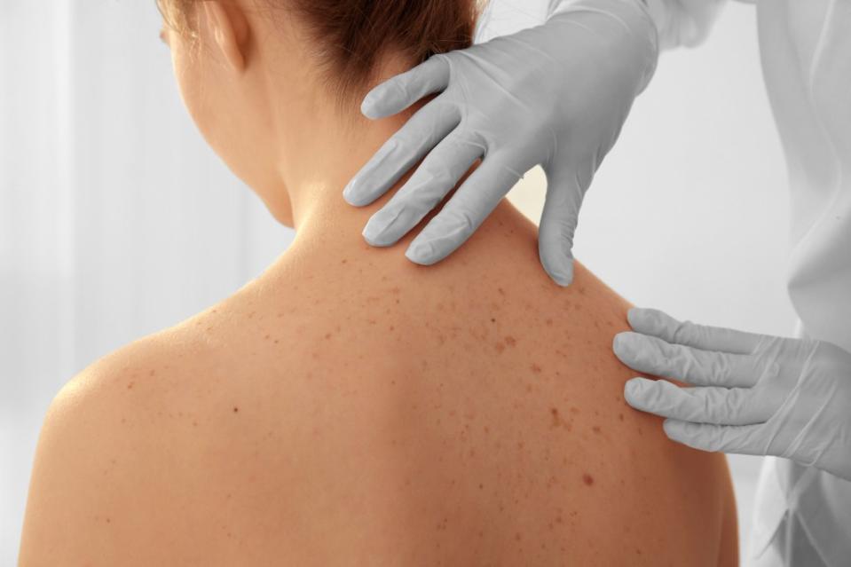 Docs recommend getting checked once a year for skin cancer. Africa Studio – stock.adobe.com