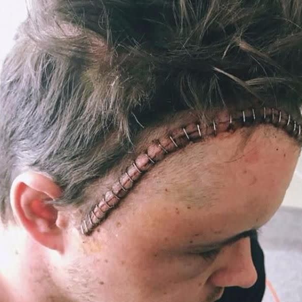 Johnny's head, after his surgery to remove the brain tumour. Source: Instagram/Johnny Ruffo