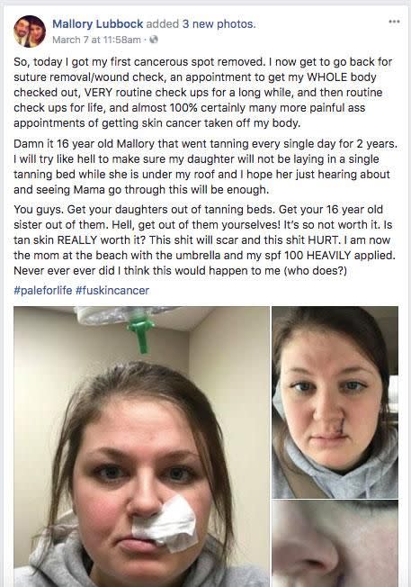 Blaming her 16-year-old self for making the poor choice to tan, the mother-of-two now realises how impactful those decisions have become, although she previously believed that this would never happen to her. Source: Facebook/Mallory Lubbock