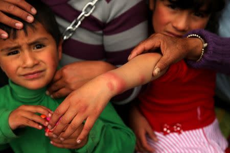 Residents of the town Cerro de Pasco in the Peruvian Andes show skin rash in their children's hands, as they protest for what they describe as rampant pollution from a sprawling polymetallic mine operated by Peruvian mining company Volcan, outside of the health ministry in Lima, Peru June 22, 2017. REUTERS/Mariana Bazo