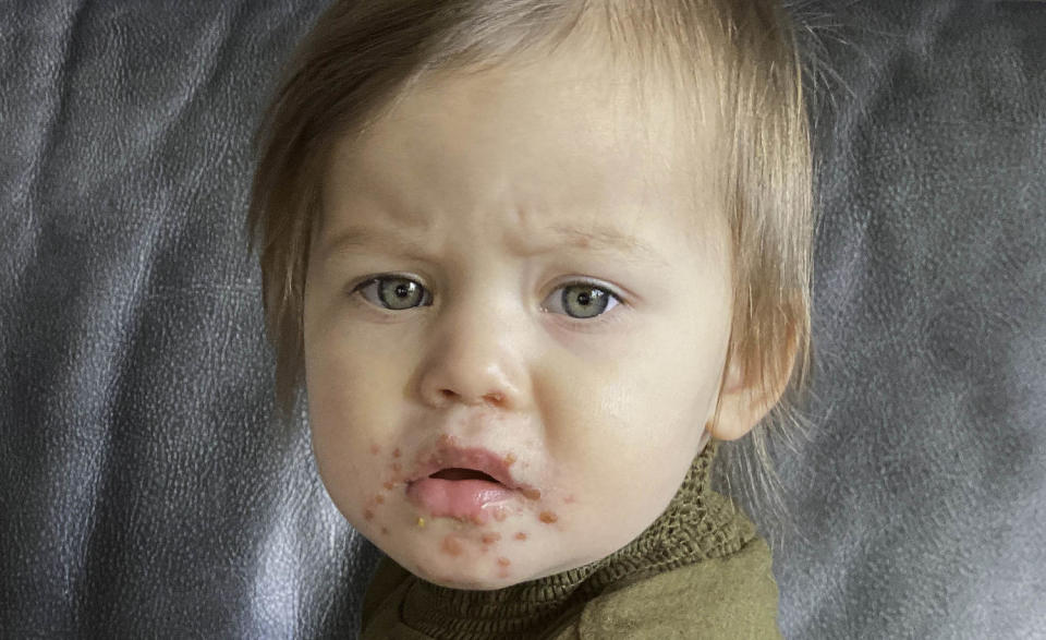 Hand Foot and Mouth virus (Getty Images)