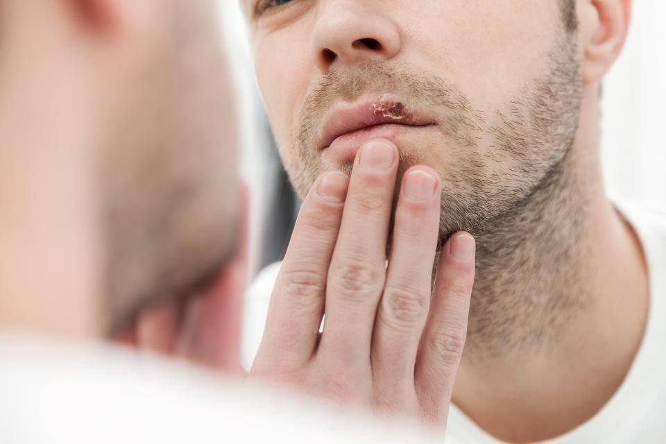 Herpes ist schmerzhaft und kommt leider meistens immer wieder. (Foto: Getty)