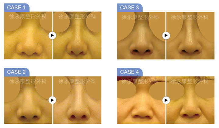 打造自然立體五官不是夢 精緻美鼻打造出個人的北鼻魅力