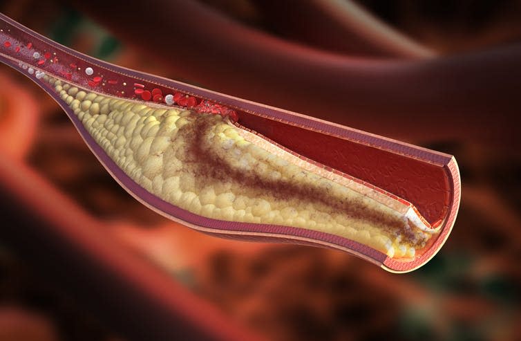 <span class="caption">Atherosclerotic plaque.</span> <span class="attribution"><a class="link " href="https://www.shutterstock.com/download/confirm/181080389?src=kSDkCjifNn2DBfqH1q6cbw-1-0&size=medium_jpg" rel="nofollow noopener" target="_blank" data-ylk="slk:Rocos/Shutterstock;elm:context_link;itc:0;sec:content-canvas">Rocos/Shutterstock</a></span>