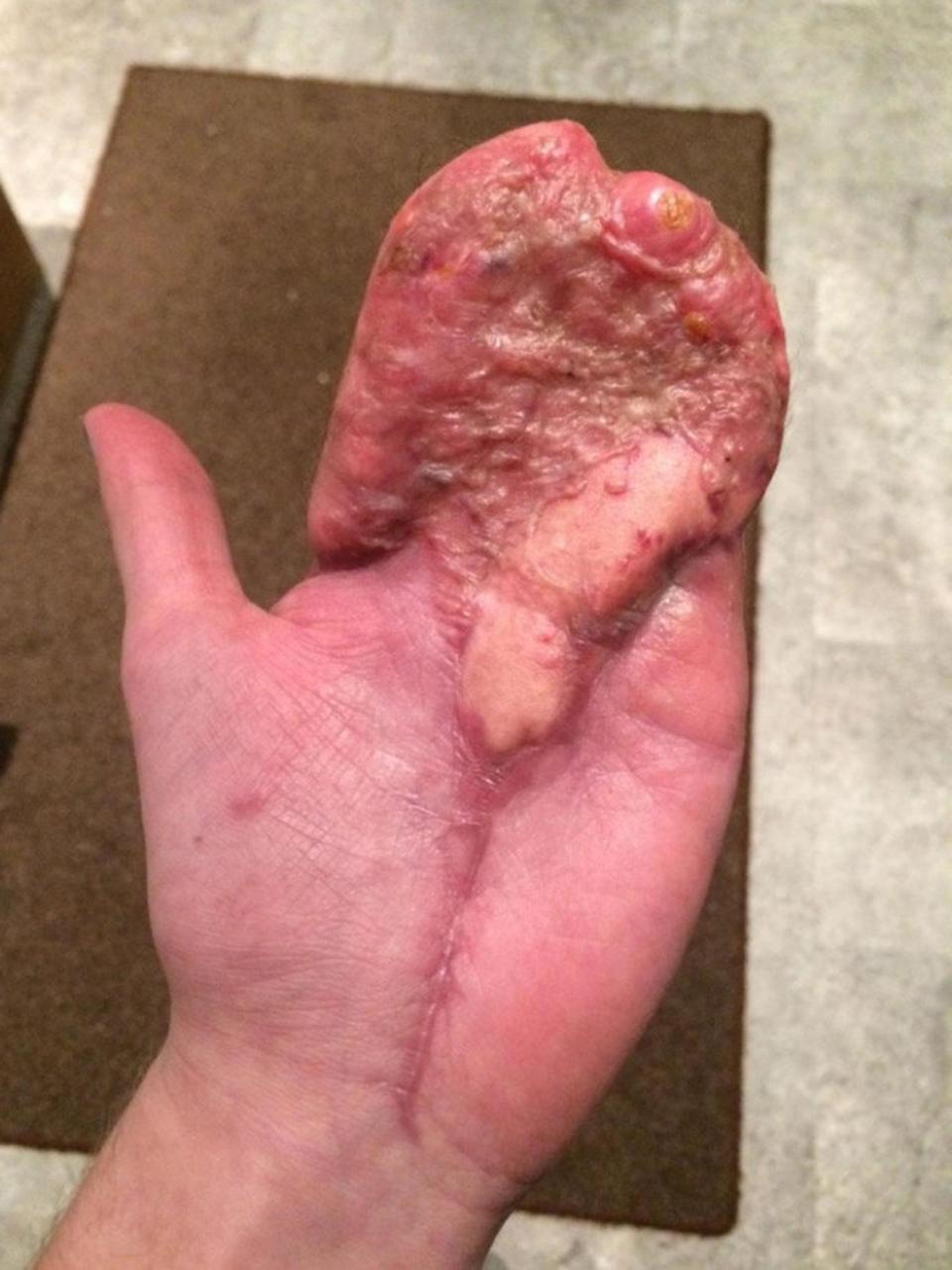 Although the tips of his fingers were amputated in the accident, they may eventually be replaced by transplants from his toes (SWNS)