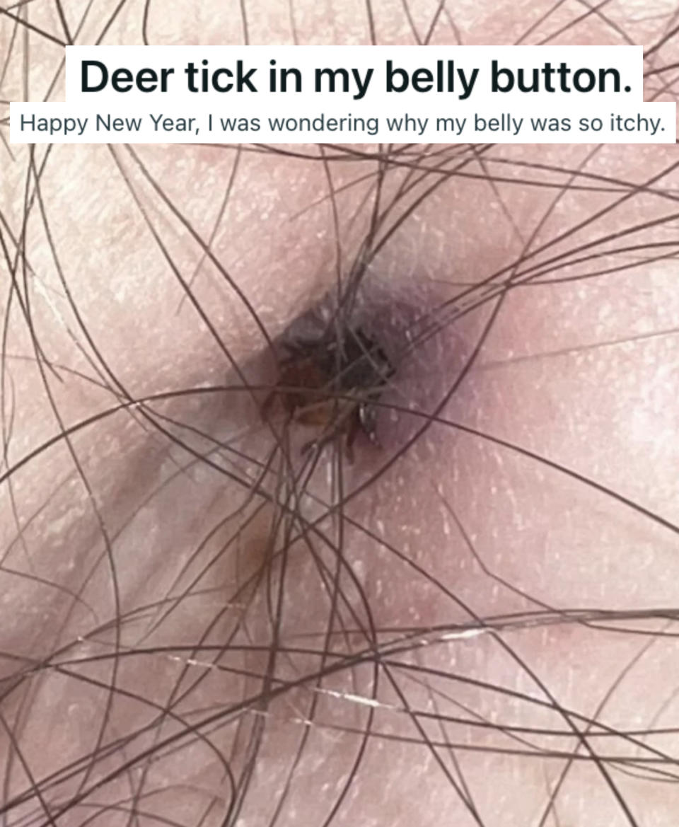 "Deer tick in my belly button"