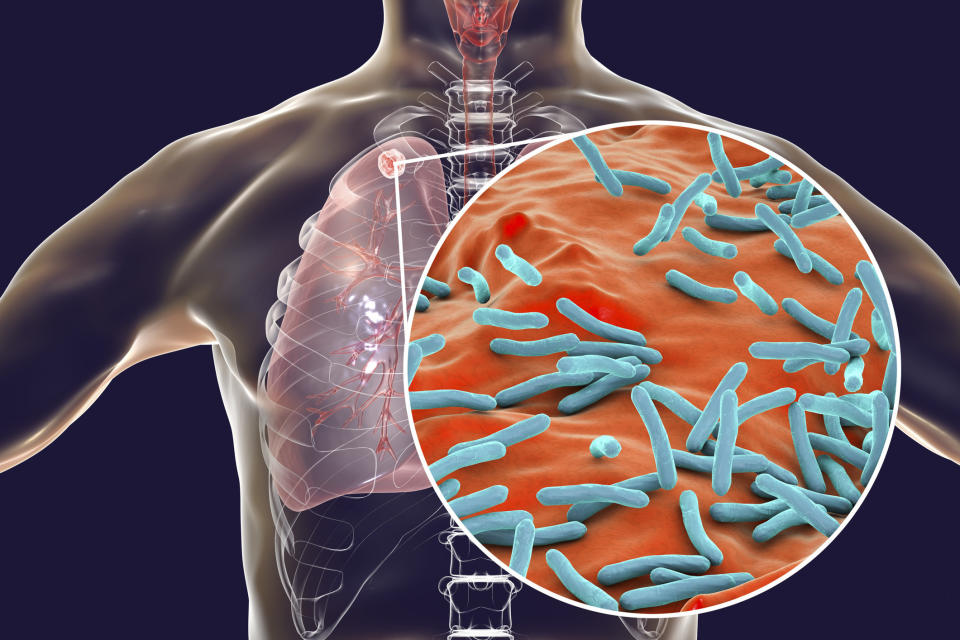 a close up of tuberculosis bacteria in lungs