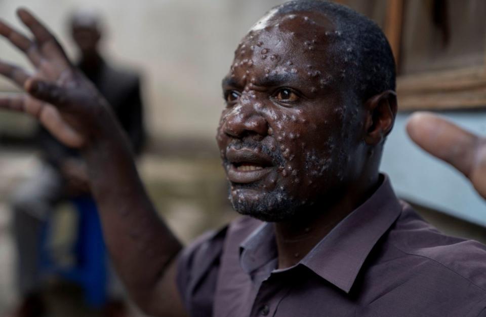 Jean Kakuru Biyambo, 48, a father of six, has been receiving treatment against mpox. Symptoms include a painful rash, enlarged lymph nodes and fever (Reuters)