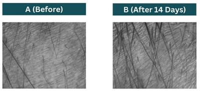 Area measured for hair length before (A) and after 14 days of using the product (B)