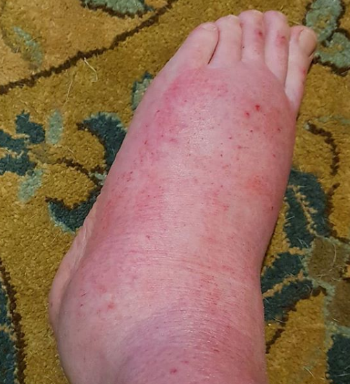 The 52-year-old mum's foot is seen red and swollen, with some spots of blood. Source: Anita Carden