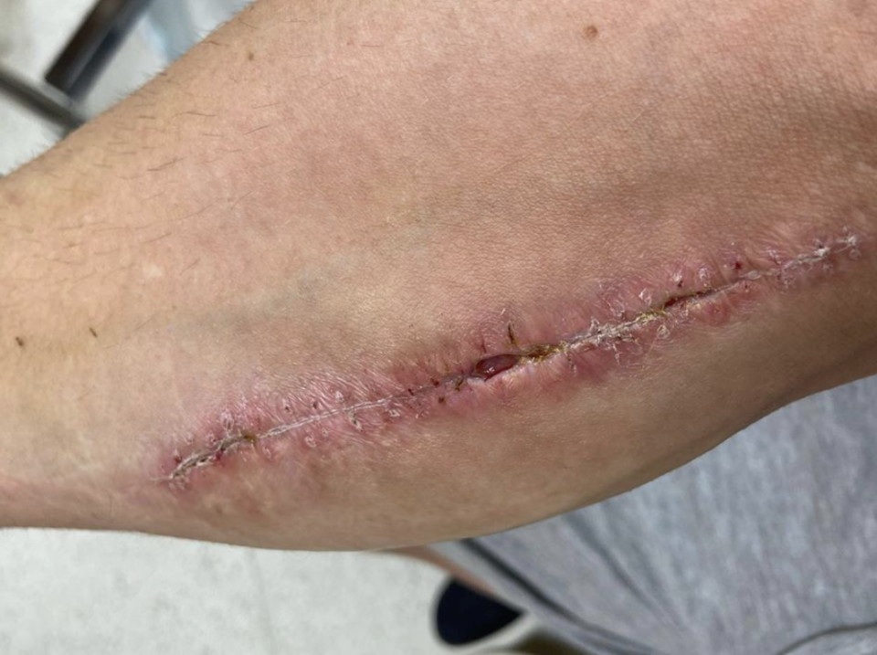 Cal Crutchlow shared images of his surgery (pictured), which her censored on Instagram.