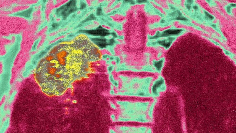  A scan of human lungs, depicted in dark red and pink, with a cancerous tumor in the upper right lung shown in yellow and orange 