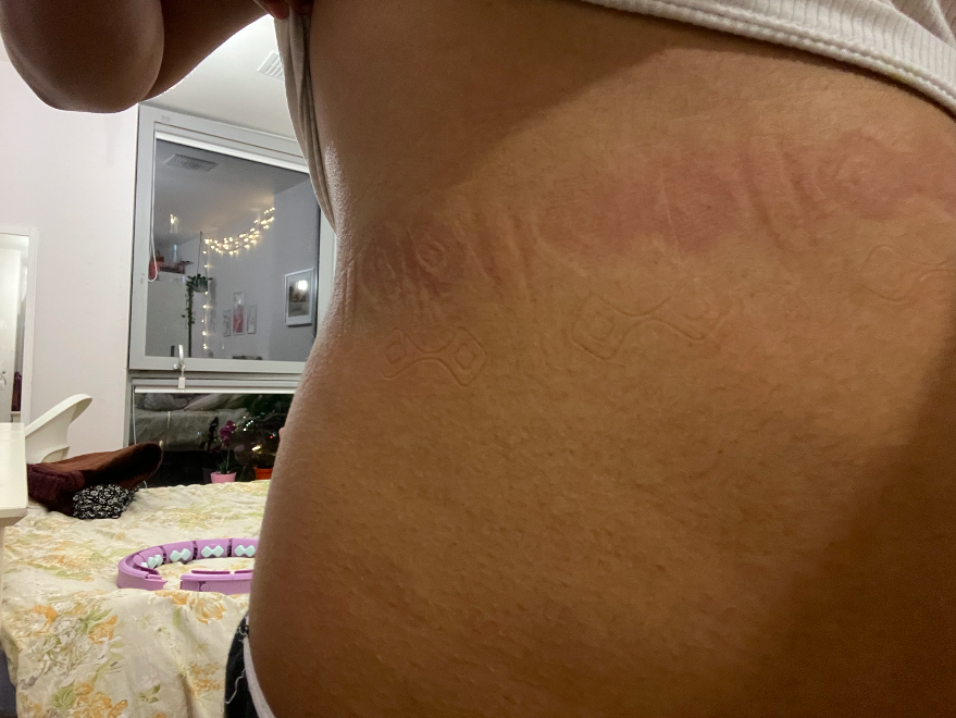 <span class="caption">My weighted hula hoop often left marks on my torso</span>