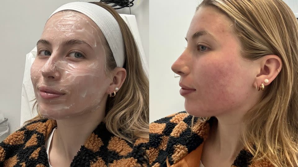 Left: Prepping for Candela Matrix Pro Radiofrequency Microneedling. Right: After the treatment. - Stephanie Griffin/CNN Underscored