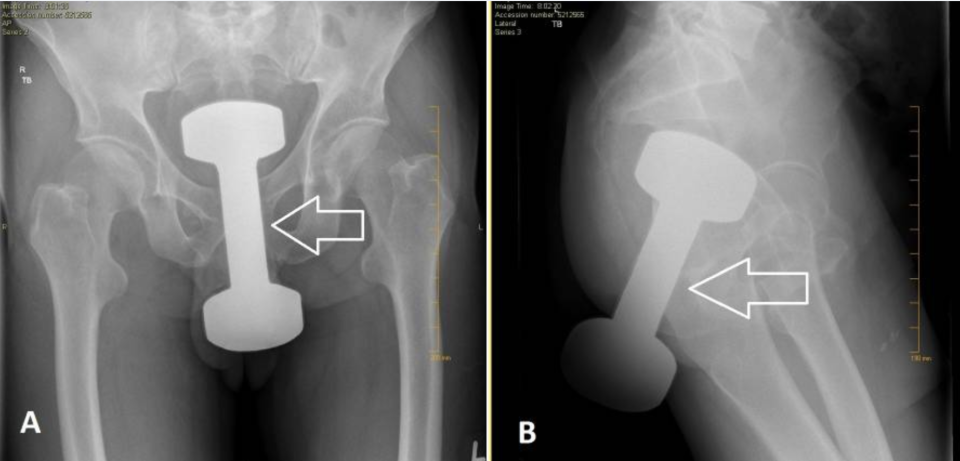 X-ray from a case study from 2018 of a dumbbell in a 50-year-old man. 