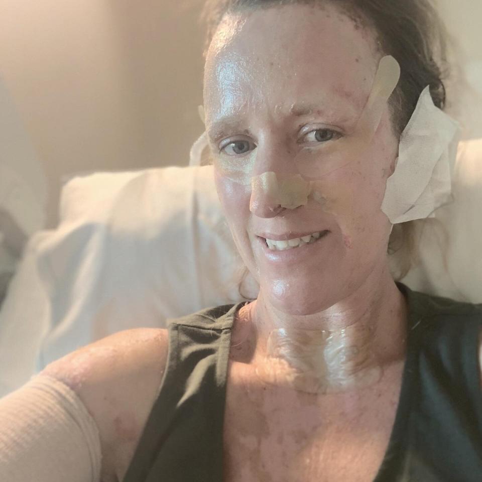 Kate Collins recovering from burns suffered in the April 27 incident.