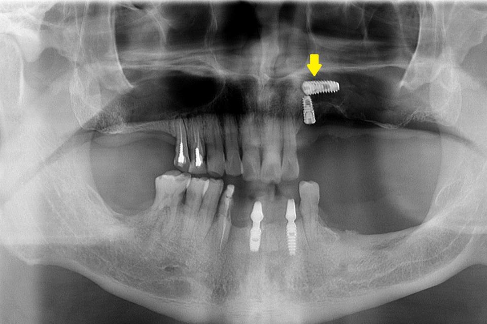 植牙的人工牙根掉入鼻竇。（圖／台北慈濟醫院提供）