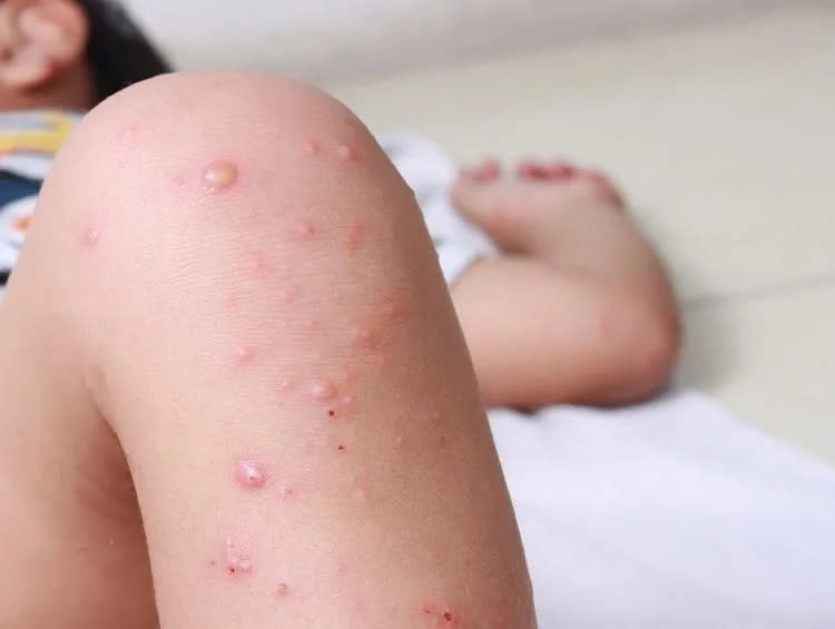 <strong>多半台灣人已有麻疹免疫力，不必過度恐慌（圖／常春月刊）</strong>