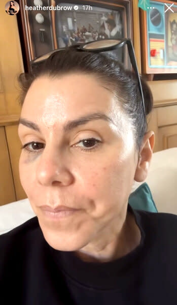 Heather Dubrow Shows the Results of Her Latest Beauty Treatment: 