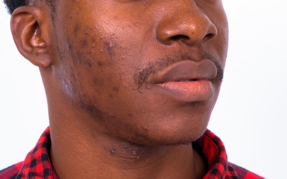 Acne is fairly universal in terms of how it looks, but there is more post-inflammatory hyperpigmentation (PIH) in darker skin, said McMichael. “The acne lesion may take 1 to 2 weeks to improve, but the PIH can last for many weeks to months.” (Getty Images)