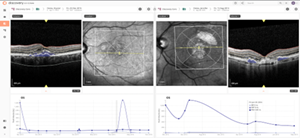 Features of the Discovery CORE platform displayed include the overlay of AI on OCT images to visualize fluid and layers, side-by-side imaging comparisons on two different time-points or visits, and at the bottom, progression plots for retinal fluid volume of a patient over time.